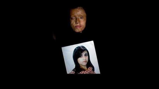 How Saira learned to smile again