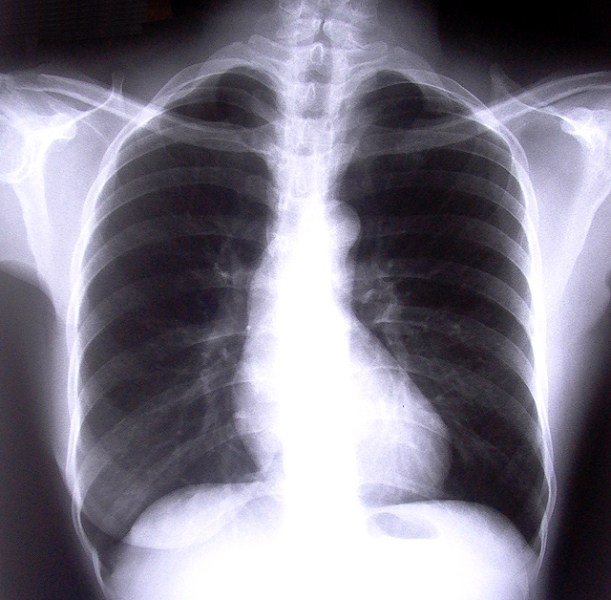 CT scans cut lung cancer deaths by 20%: Study