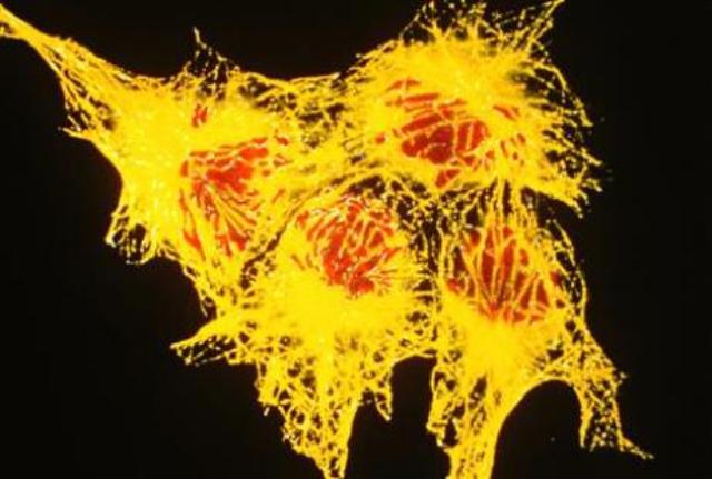 Lifestyle factors behind most cancers