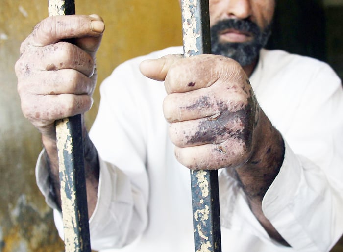File photo of the impact of just a small quantity of acid on the hands, arms. PHOTO: AFP/FILE