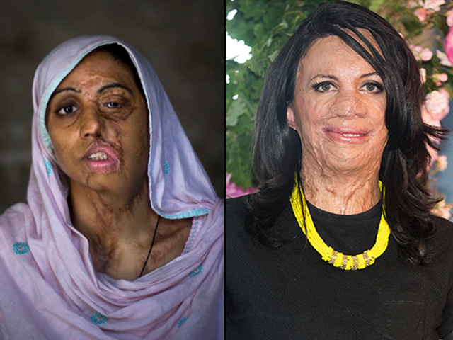Will Pakistani acid victims ever be as lucky as Turia Pitt?