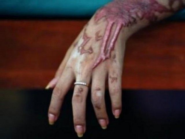 Acid attack suspects injured in encounter