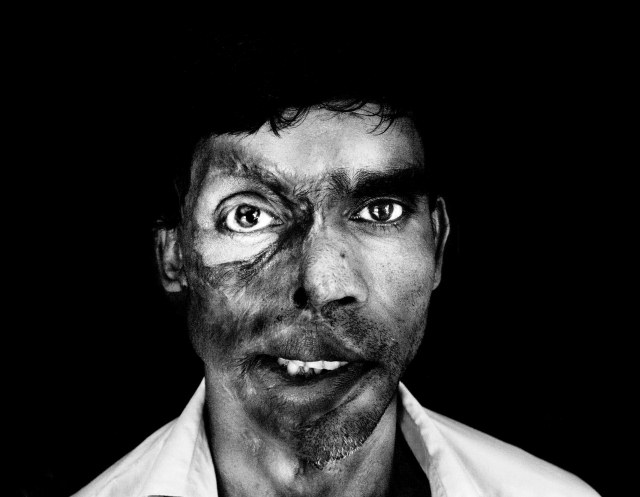 Whether the victim is a man or woman, acid attacks are no laughing matter
