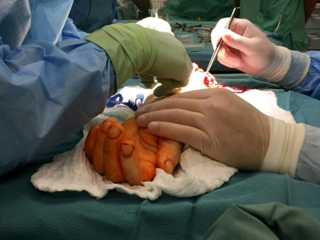 Surgeons attach a hand from a deceased donor to a man born without one at at Wroclaw Medical University Hospital. PHOTO: AFP