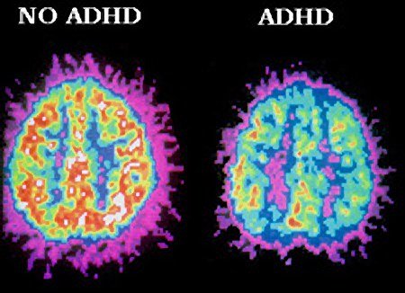Early diagnosis of mental disorder stressed