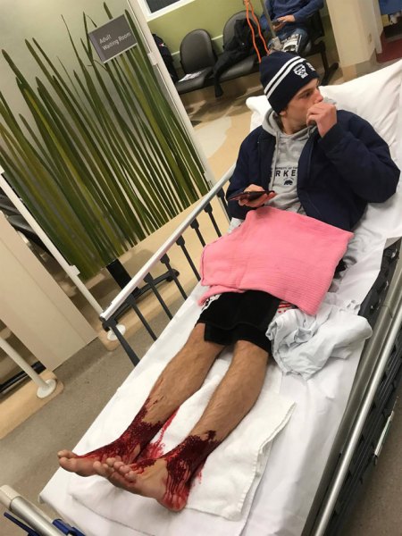 This handout picture taken and released by Jarrod Kanizay, father of Australian teenager Sam Kanizay, on August 7, 2017 shows Sam Kanizay with his injured feet waiting for medical aide at hospital in Melbourne. PHOTO: AFP
