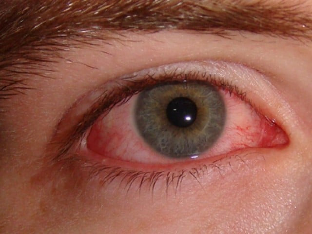 Karachi witnesses surge in eye infection amid rainy season